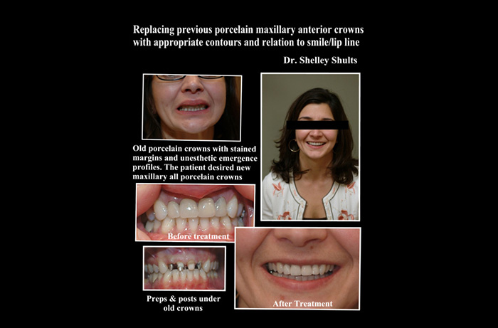 Dublin Before and After Invisalign