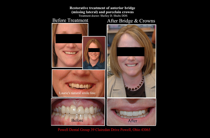 Lewis Center Before and After Veneers