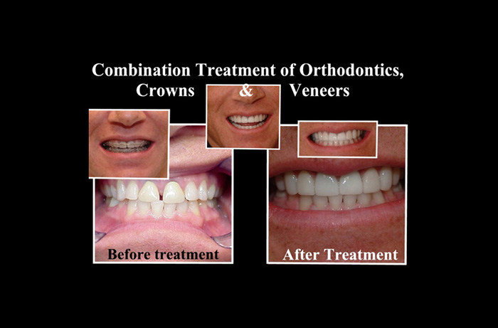 Powell Before and After Teeth Whitening