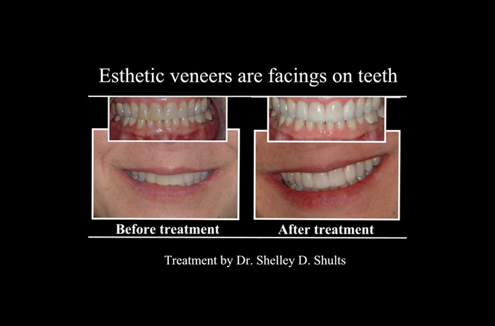 Lewis Center Before and After Veneers
