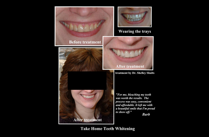 Lewis Center smile gallery