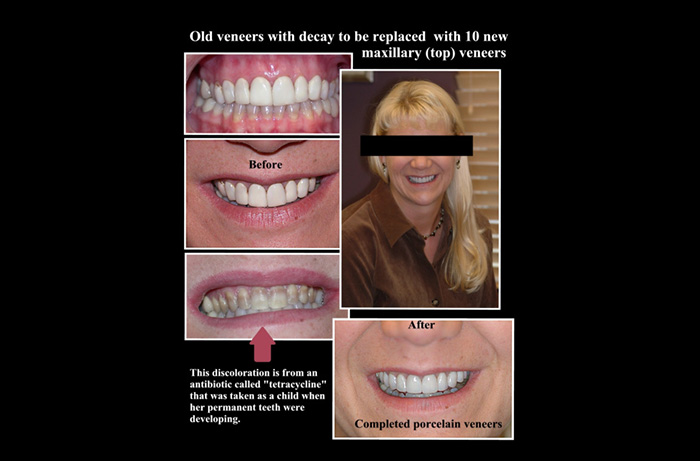 Powell Before and After Teeth Whitening